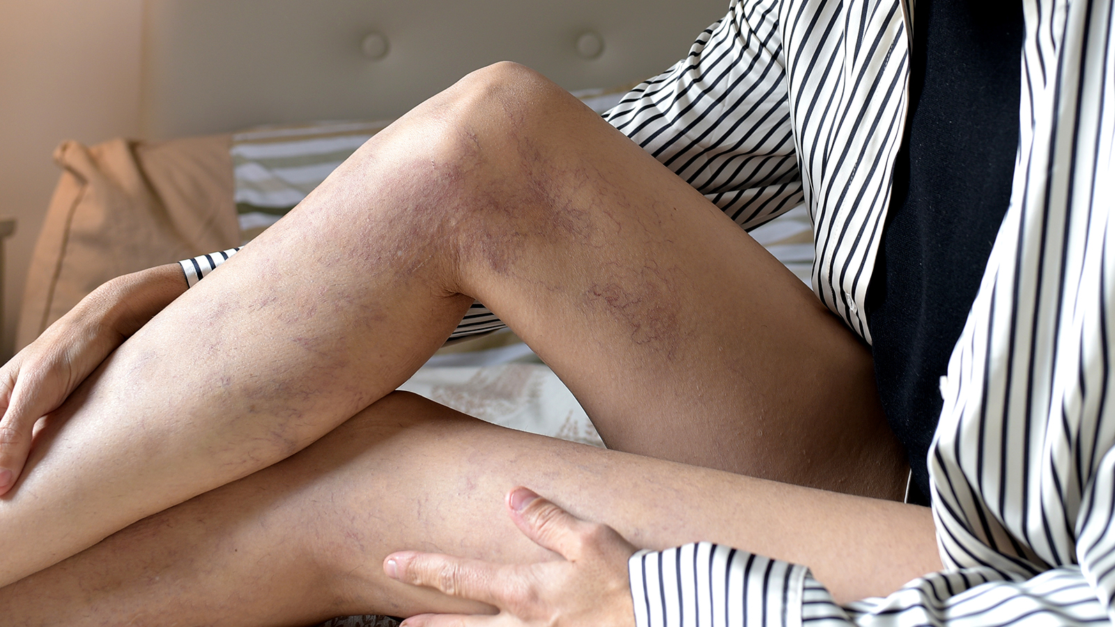 person with thread veins and varicose veins