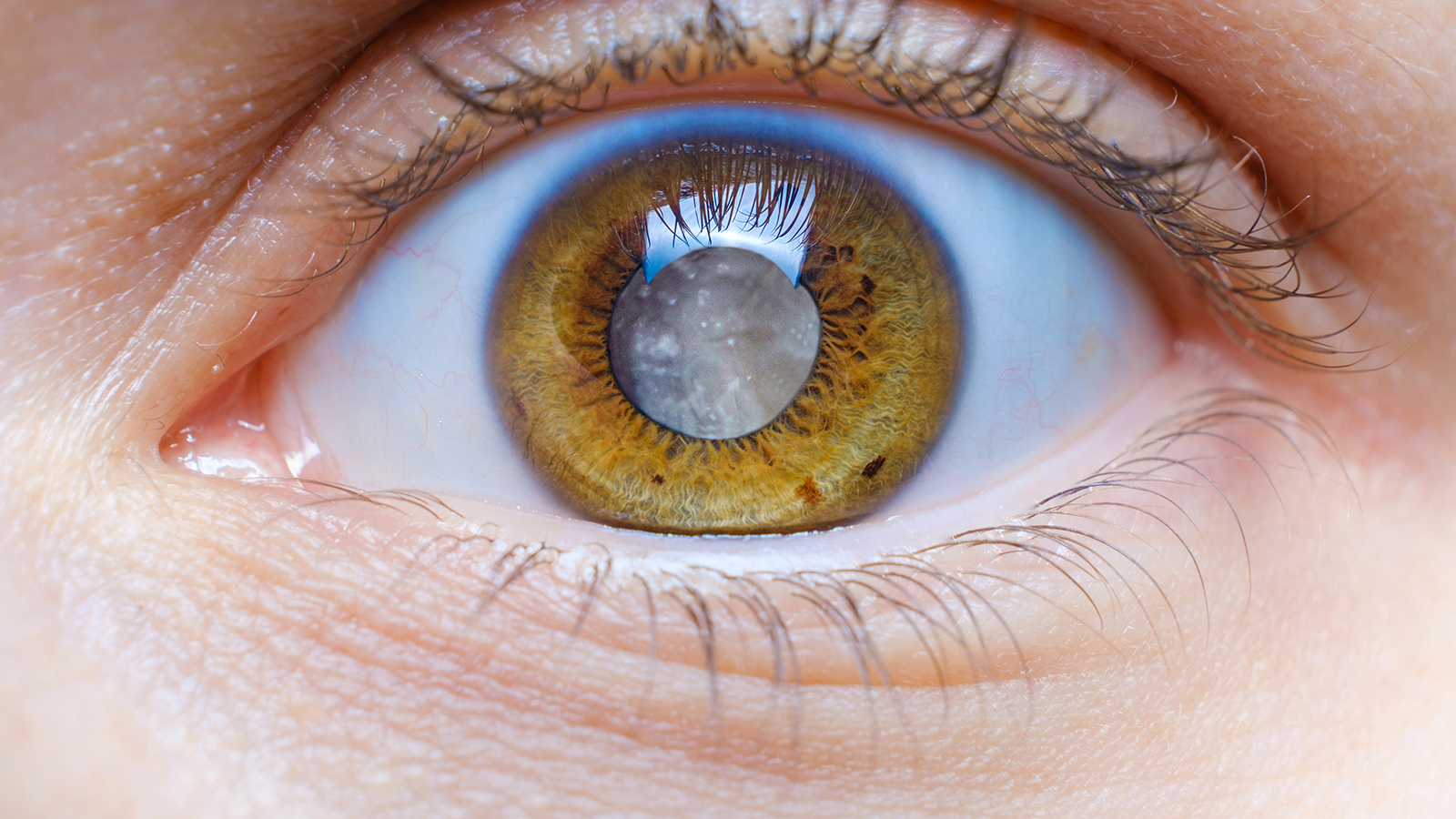 close up of an eye illustrating cataracts
