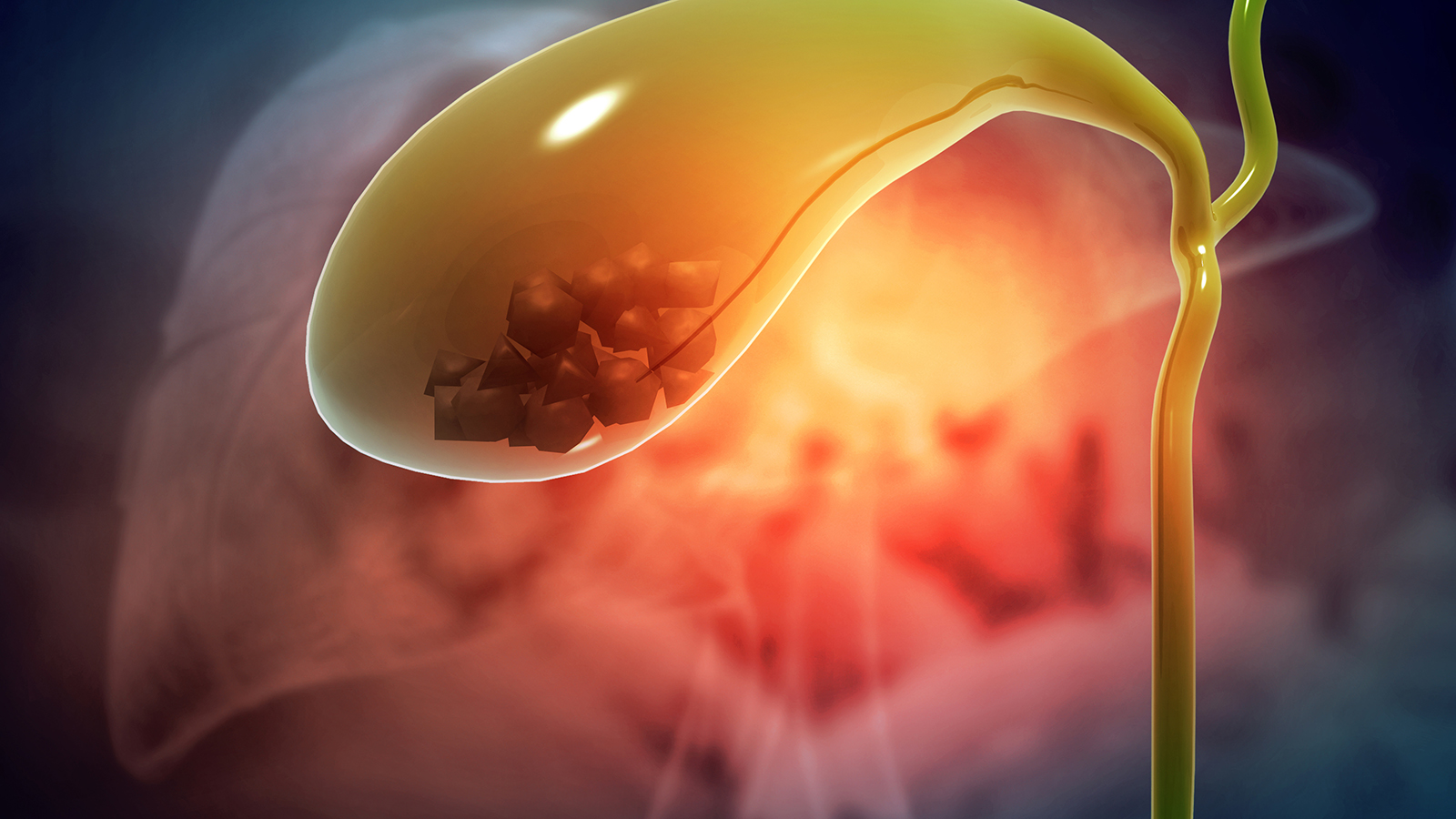 illustration of gallstones in the gallbladder