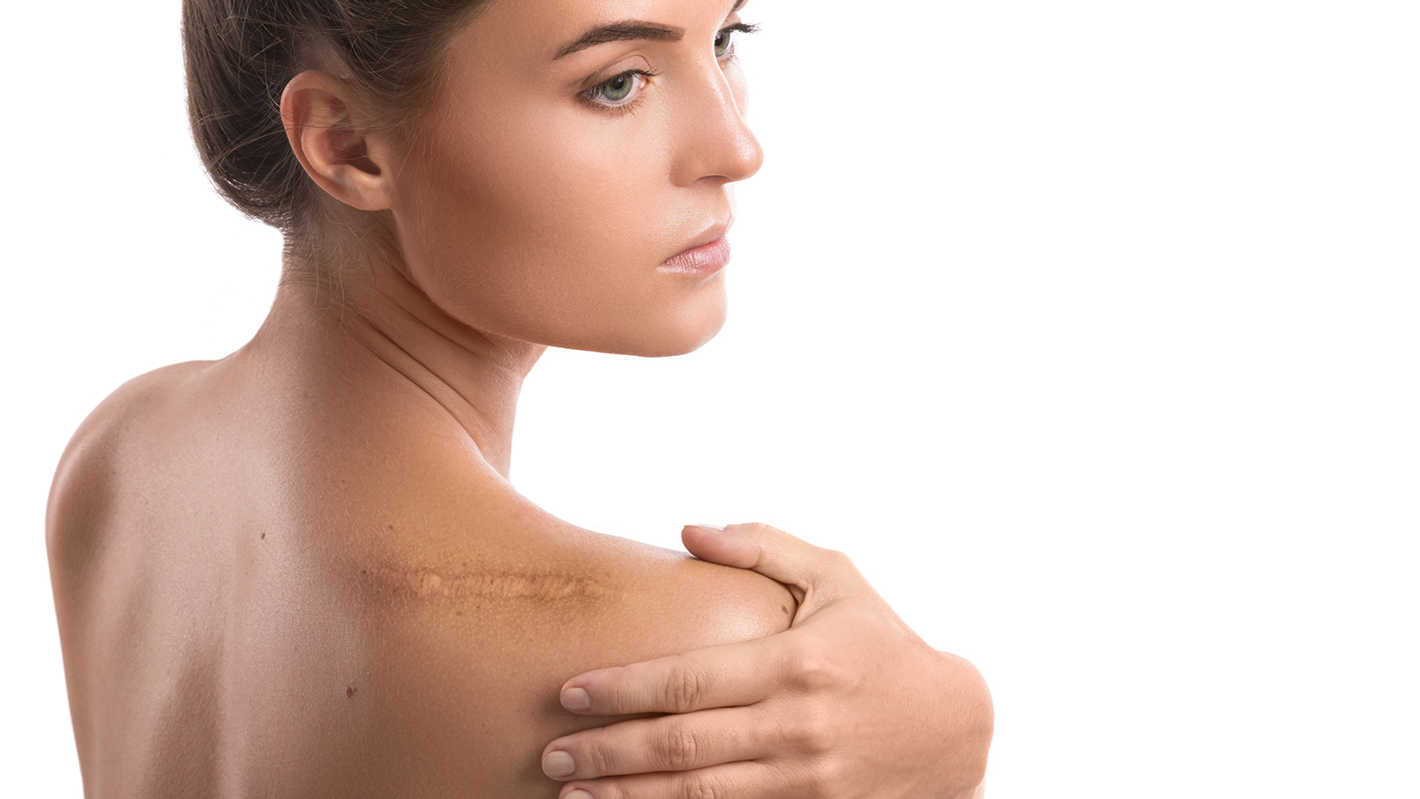 woman with a large scar on her shoulder