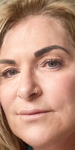 Blepharoplasty before