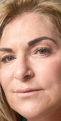 Blepharoplasty before