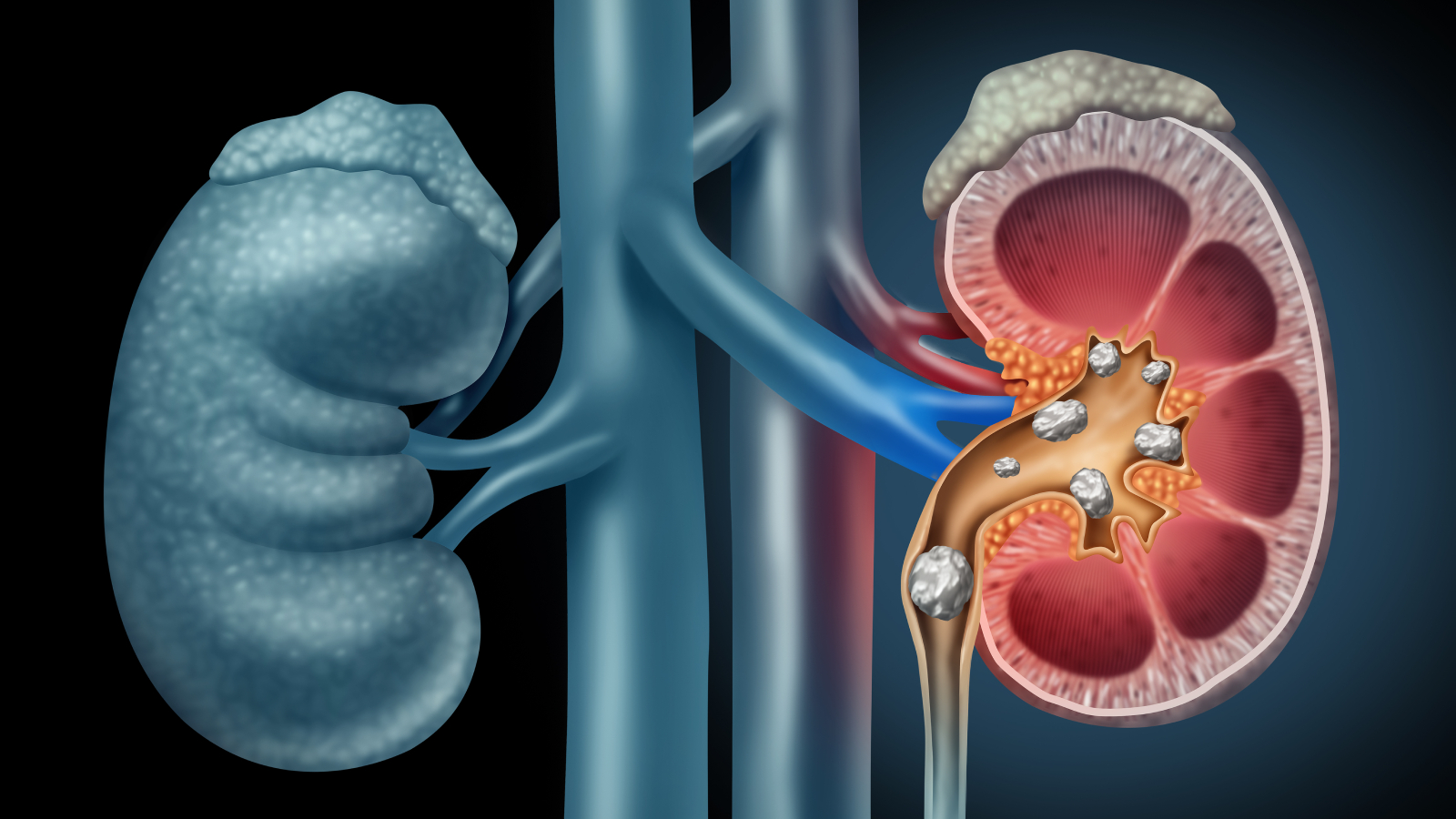 Image of a kidney with stones