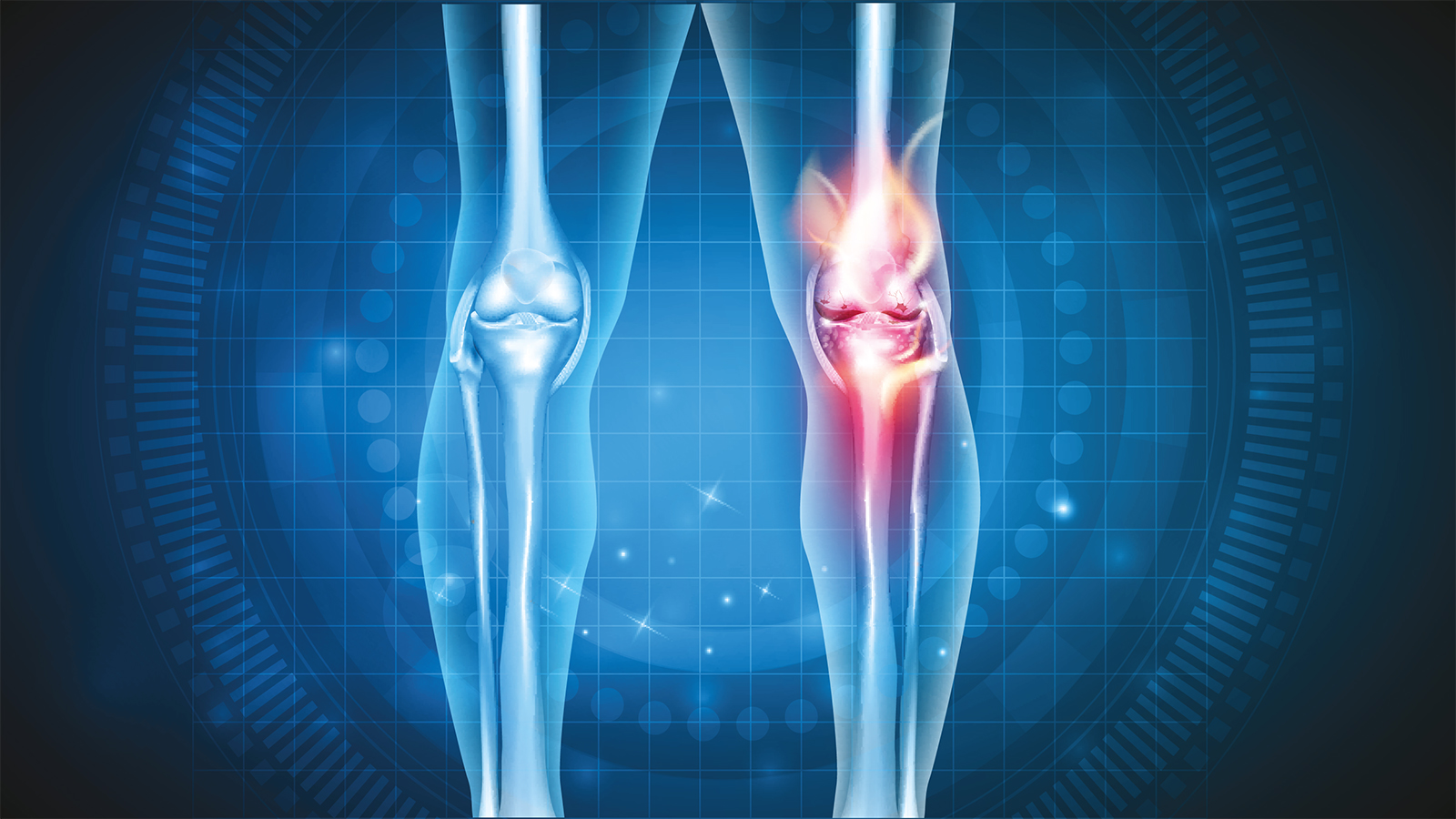 illustration showing damage and inflammation from knee artrhitis