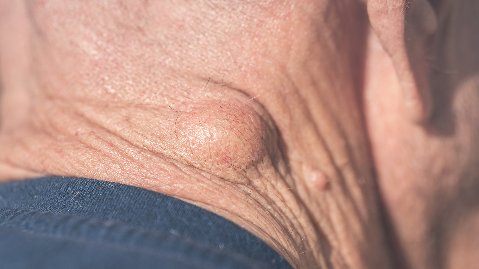 a lipoma on the back of someone'e neck