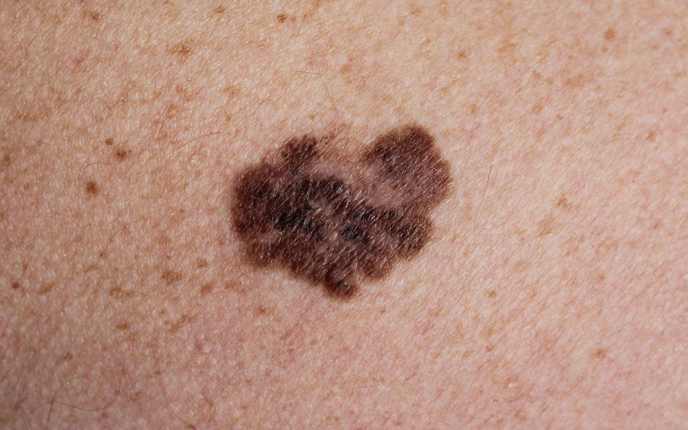 close up image of a mole