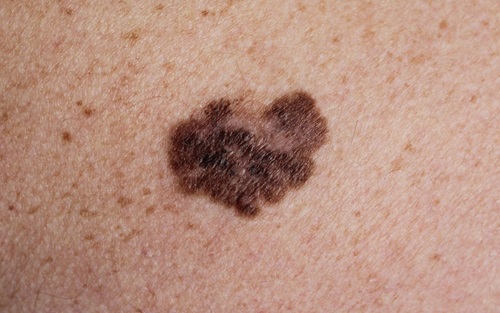close up image of a mole