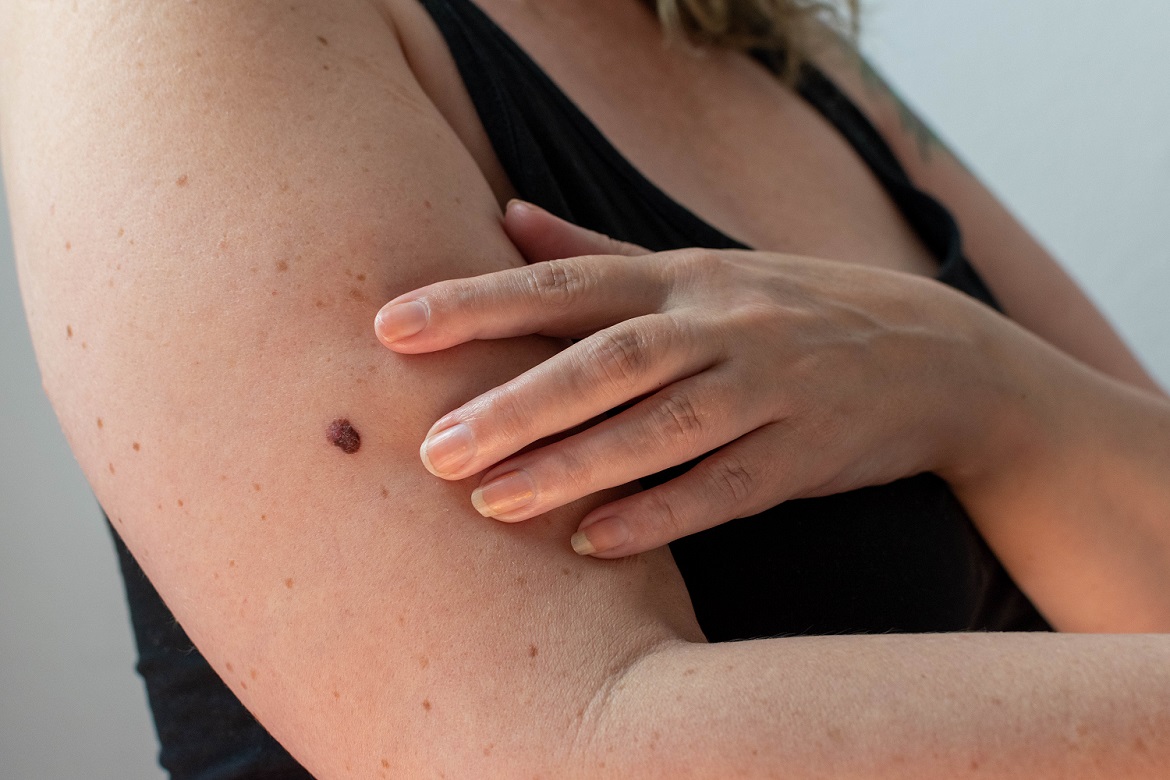 person with arm mole