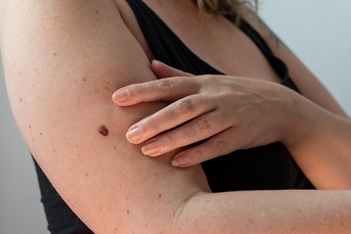 person with arm mole