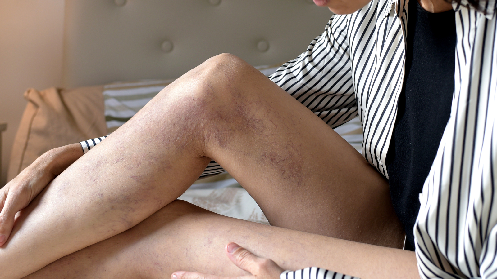 Woman examining leg for varicose veins and considering treatment options