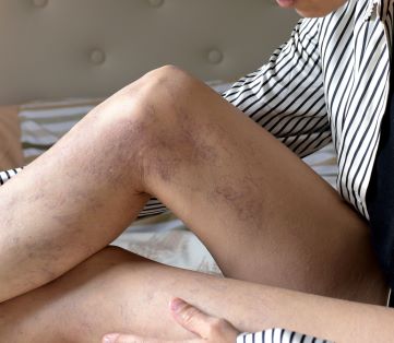 Woman examining leg for varicose veins and considering treatment options