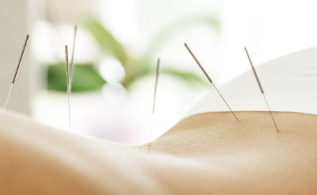 Acupuncture on patients back
