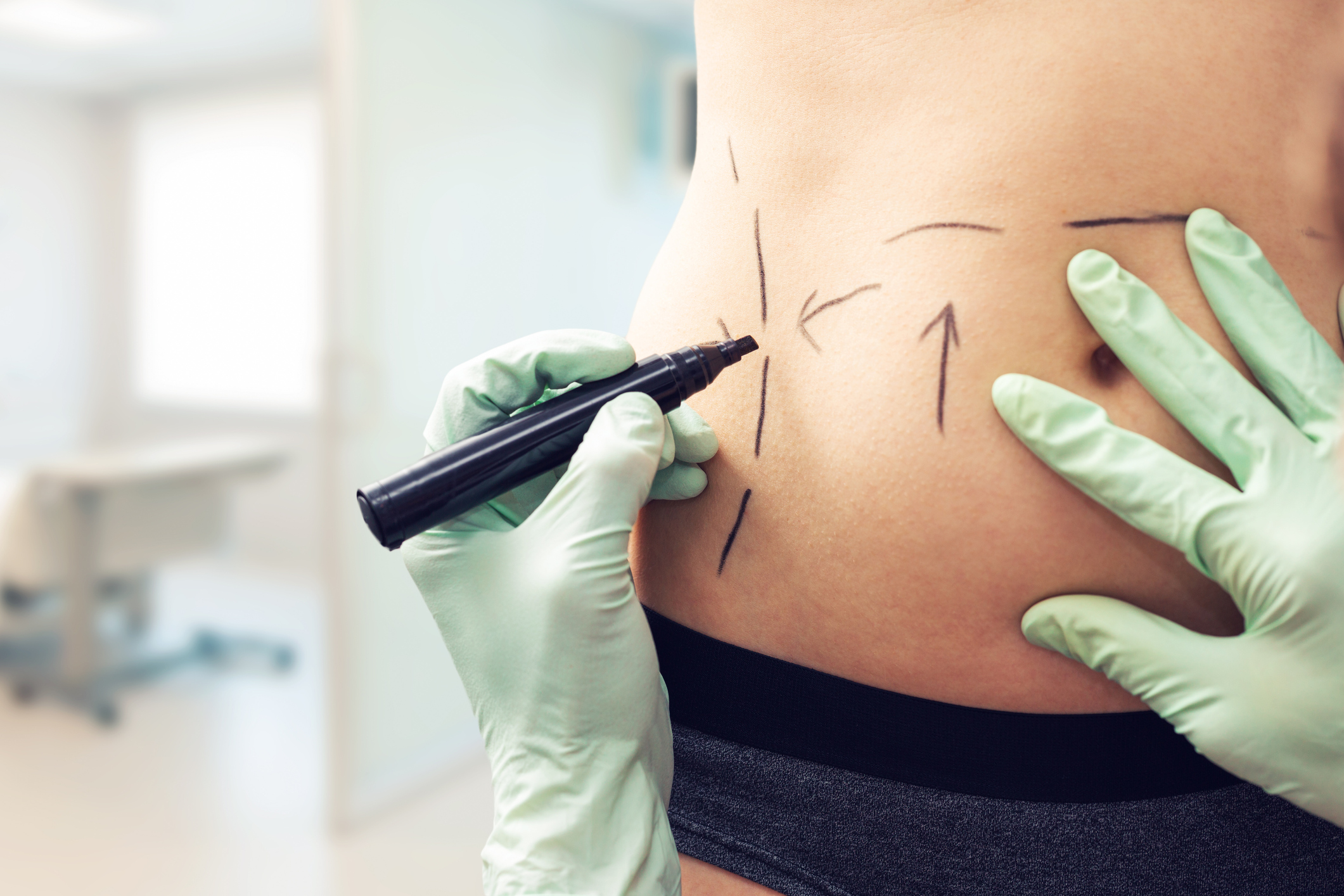 Cosmetic Surgeon marking a patient