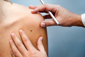 Consultant examining a patients mole