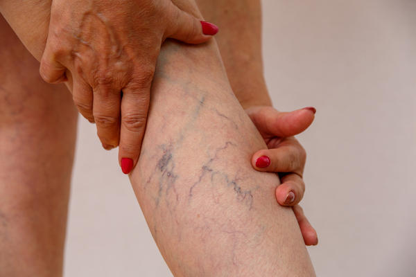 Varicose veins treatment in Essex