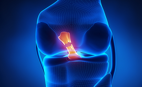 illustration of a knee with a torn ACL