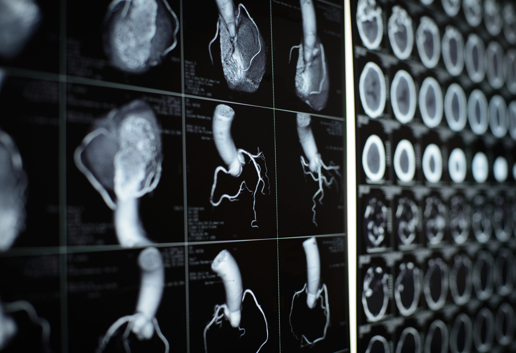 Scan images of the heart and coronary artery