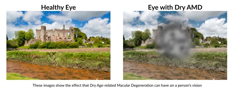 Amd Dry Simulation Photobiomodulation Light Therapy | Dry AMD Treatment in Southend