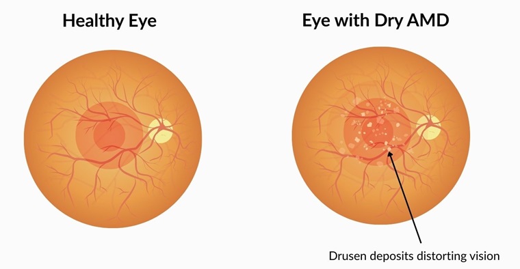Eye Injection Amd Photobiomodulation Light Therapy | Dry AMD Treatment in Southend
