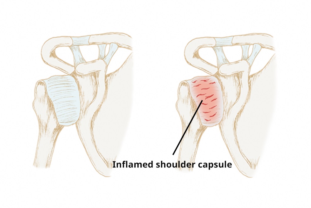 frozen shoulder
