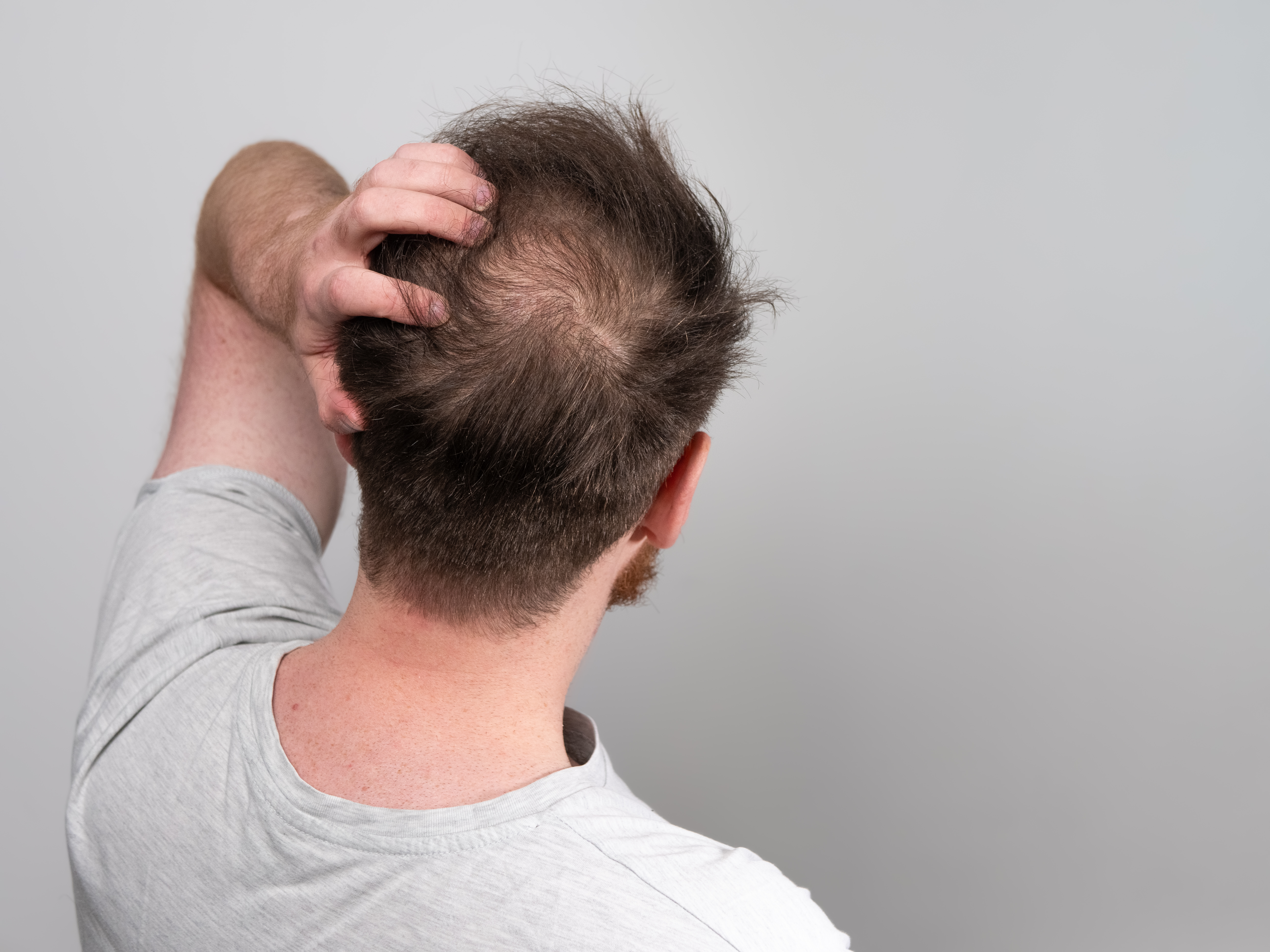 Man experiencing hair loss