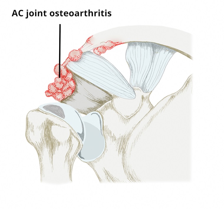ac joint osteoarthritis