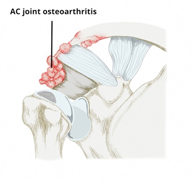 ac joint osteoarthritis