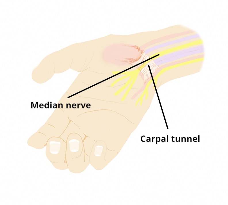 carpal tunnel syndrome