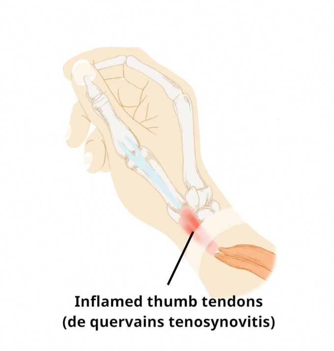 de quervains