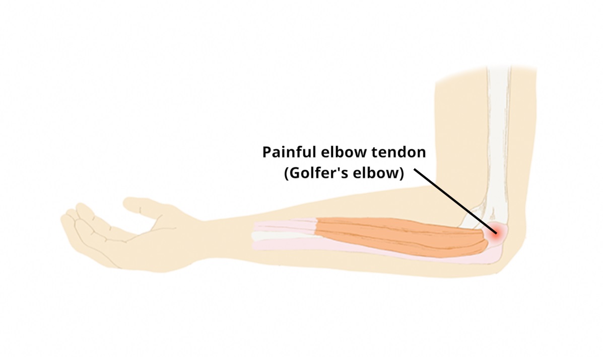golfers elbow