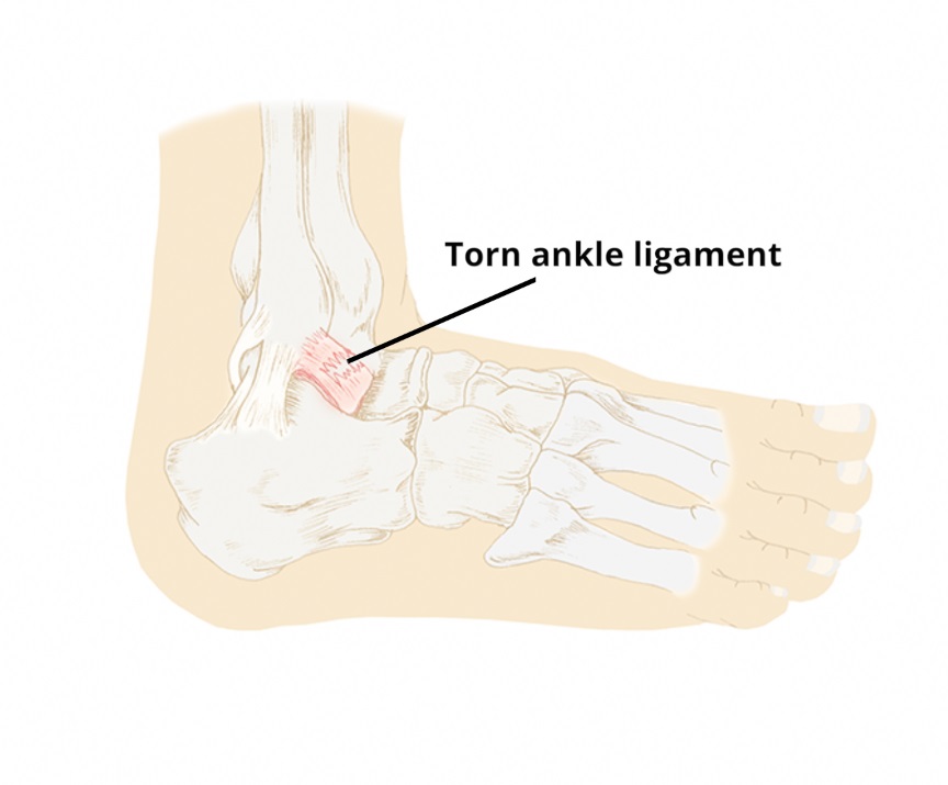 lateral ankle ligament sprain