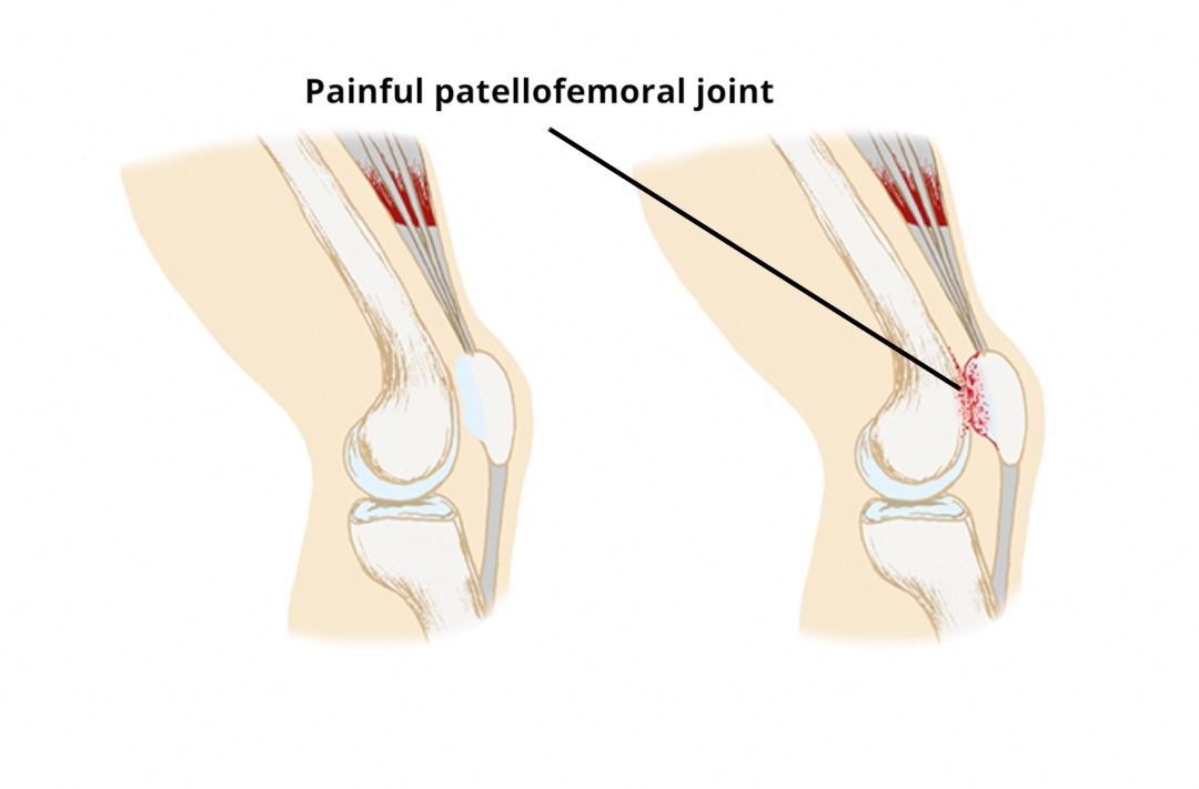 patellofemoral pain