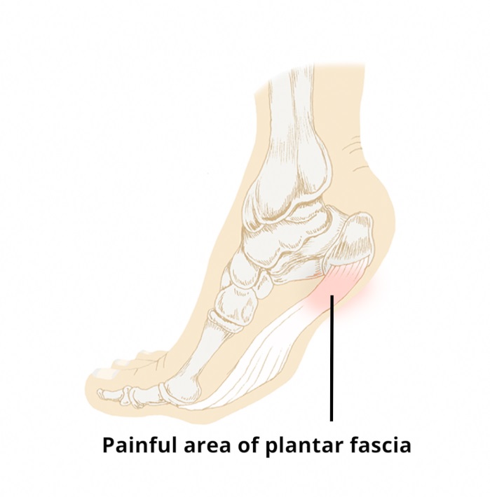plantar fascitis