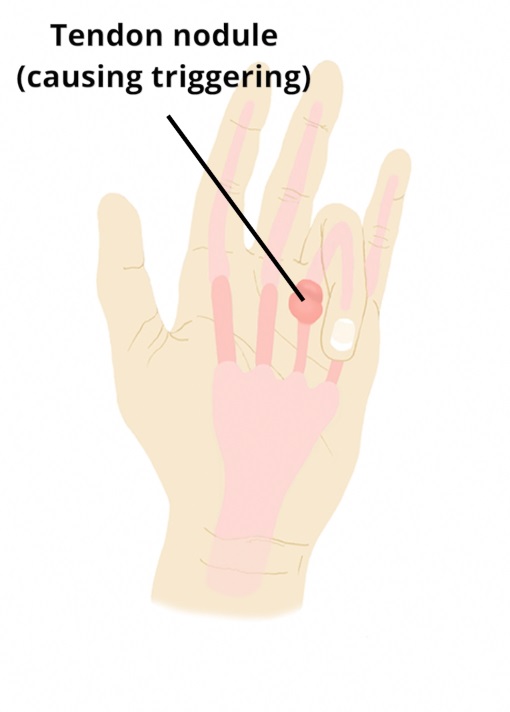 trigger finger
