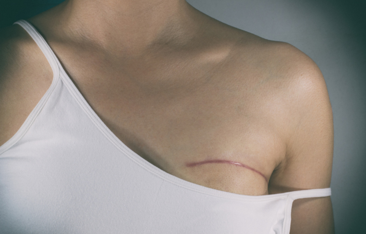 Breast lump removal scar - after lumpectomy surgery