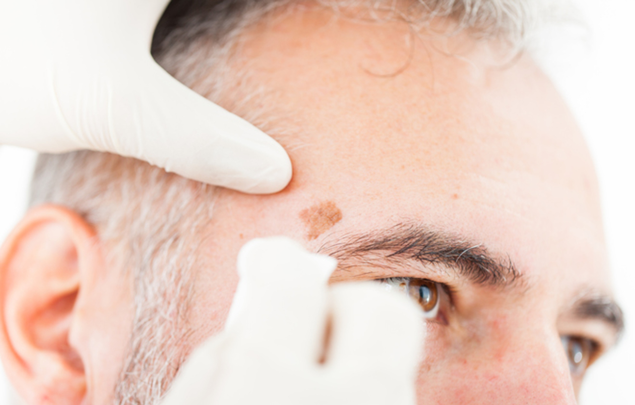 Cryotherapy treatment used to repair sun-damaged skin