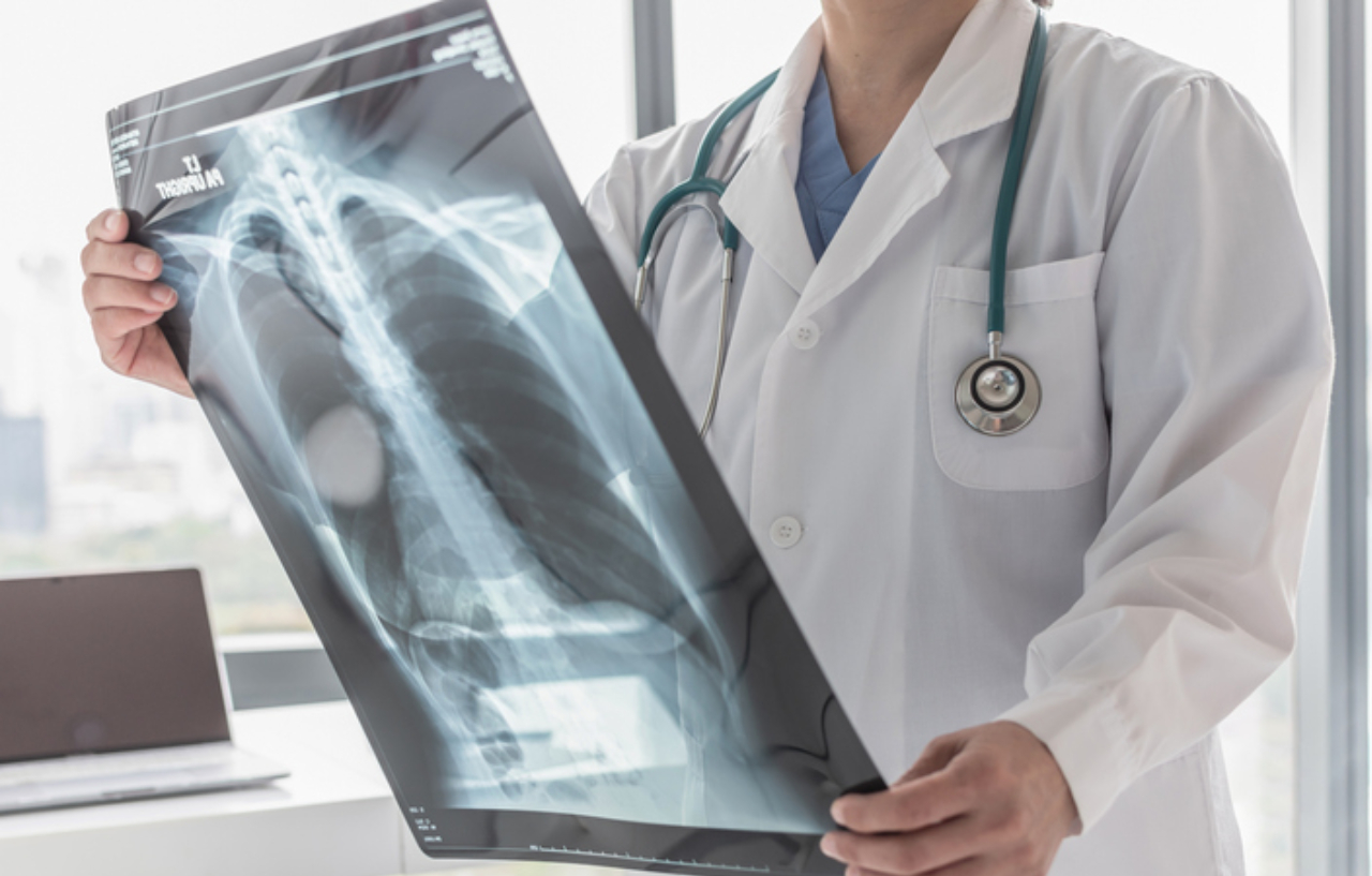 Doctor reviewing a chest x-ray before giving lung cancer treatment