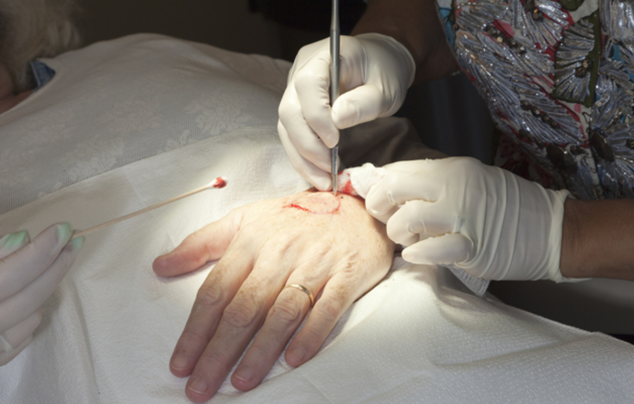 Close up of surgeon performing Mohs surgery for skin cancer