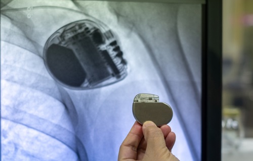 Heart Failure Pacemaker Heart failure treatment