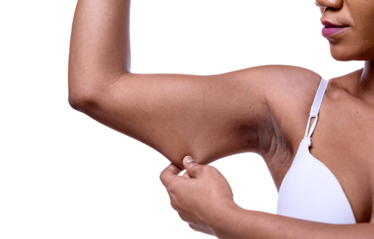 Woman pulling loose skin wants an upper arm lift to recontour her arm