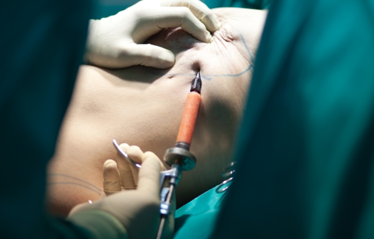 Close up of breast reconstruction following mastectomy surgery
