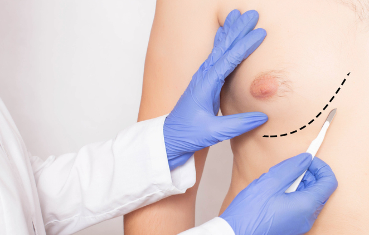 Male-Breast-and-Nipple-Reduction
