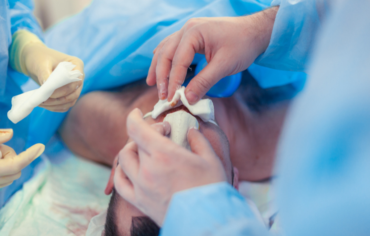 Surgeon and their assistant performing a rhinoplasty (nose job)