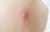 close-up abscess on child skin