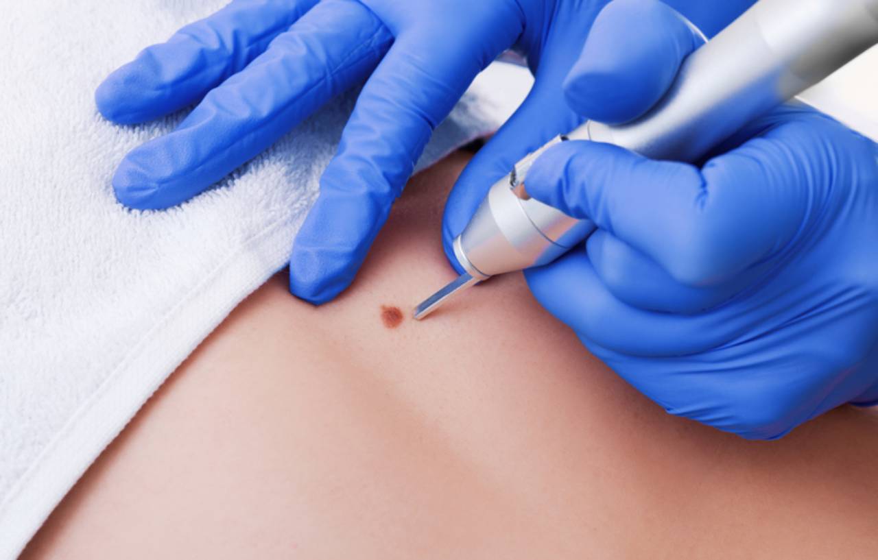 Close up of skin lesion removal surgery using liquid nitrogen