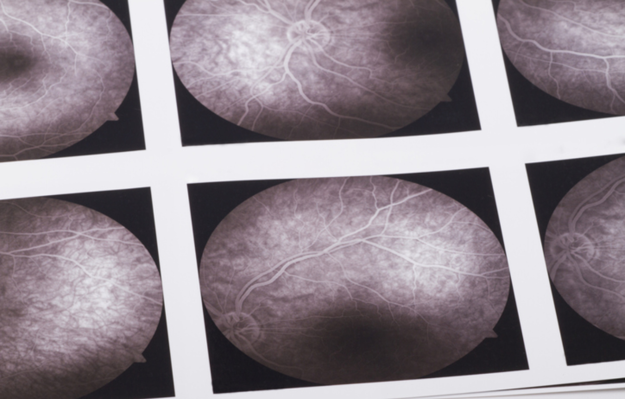 Eye angiogram print to help with correcting a squint in a child