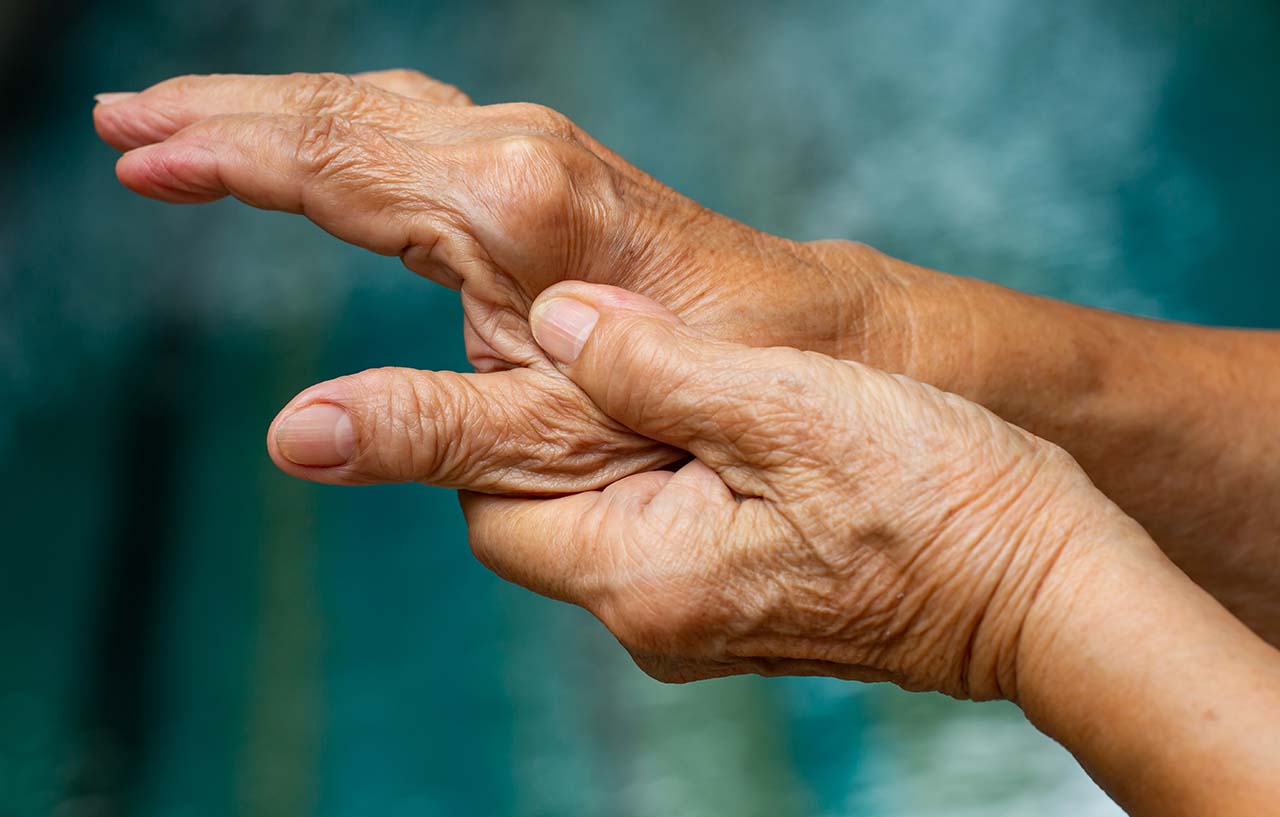 Hand with swelling caused by De Quervain's tenosynovitis syndrome