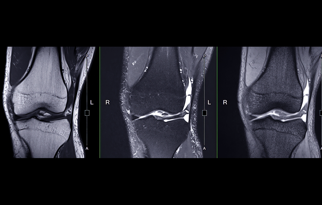 mri-of-knee-joints