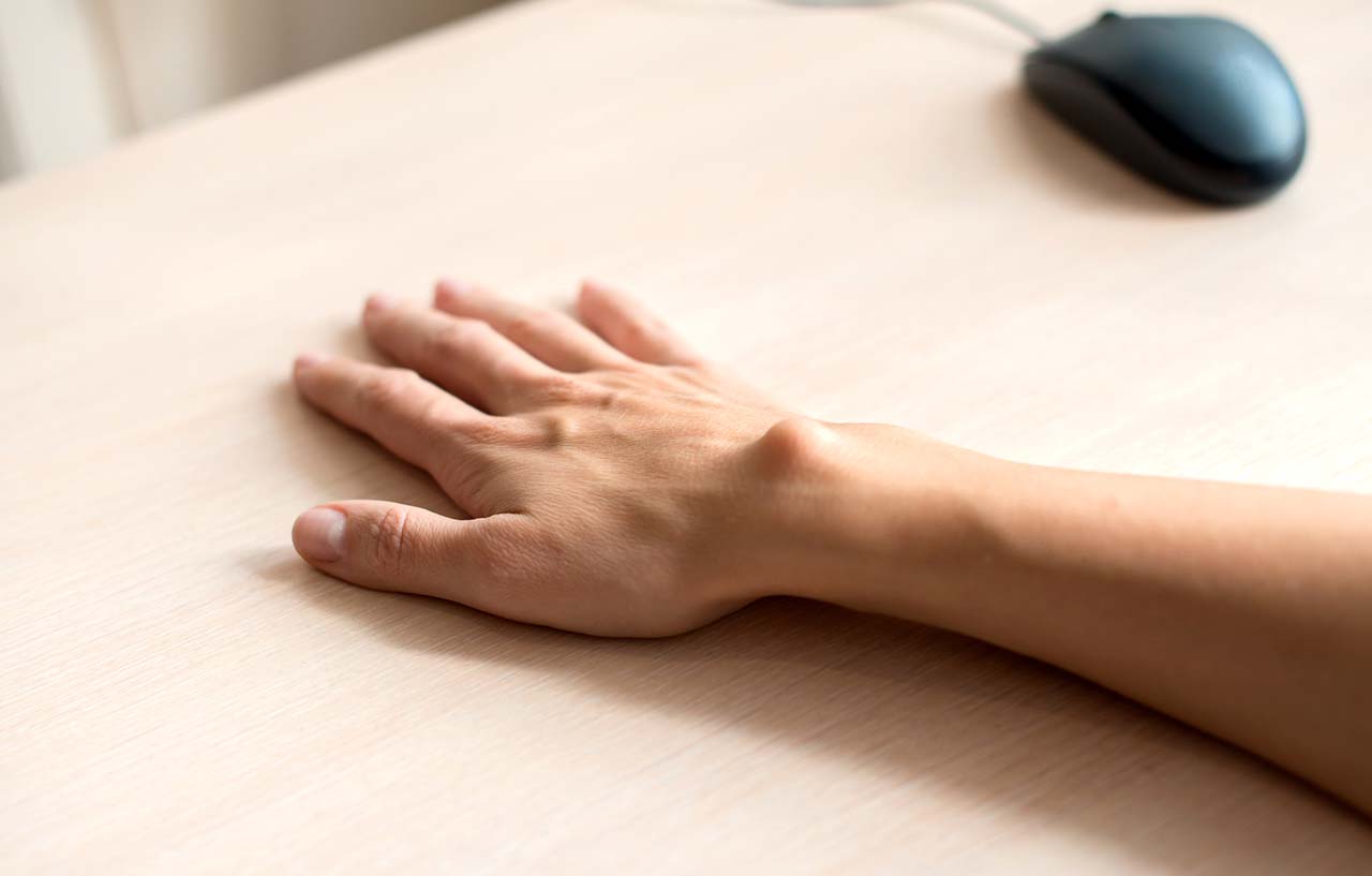 Female hand with a ganglion cyst on her wrist, resting on a desk