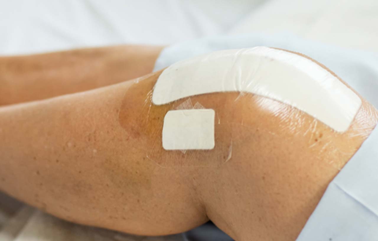 Patients knee with bandages and medical coverings on areas of incision after surgery